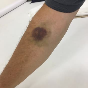 Dr. Turanşah Tümer 'de Hacamat Pişmanlık