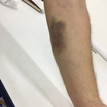 Dr. Turanşah Tümer 'de Hacamat Pişmanlık