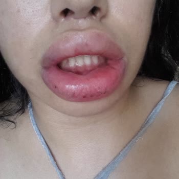 Dr. Ali Mezdeği Çene Ameliyatından Sonra Ağzım Aşağıya Düştü