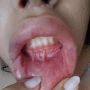 Dr. Ali Mezdeği Çene Ameliyatından Sonra Ağzım Aşağıya Düştü