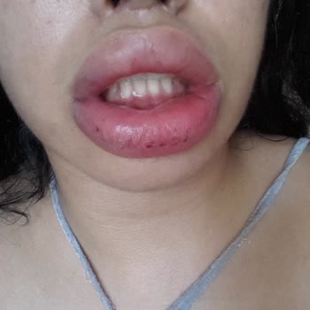 Dr. Ali Mezdeği Çene Ameliyatından Sonra Ağzım Aşağıya Düştü