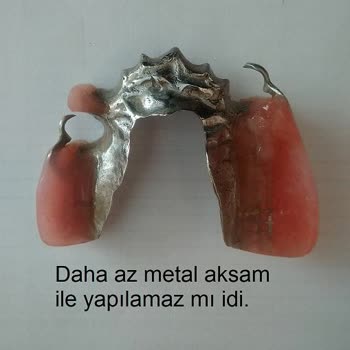 İzmir Eğitim Diş Hastanesi Hatalı Protez Yapımı.