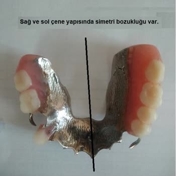 İzmir Eğitim Diş Hastanesi Hatalı Protez Yapımı.