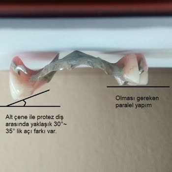 İzmir Eğitim Diş Hastanesi Hatalı Protez Yapımı.