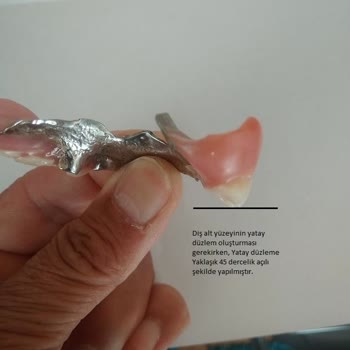 İzmir Eğitim Diş Hastanesi Hatalı Protez Yapımı.