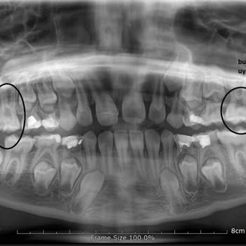 Hospitadent Diş Hastanesi Pedodontist Hatası Sonrası İlgisizlik