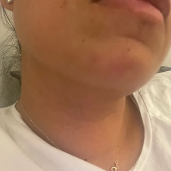 Yves Rocher Anti AGE Global Gündüz Yüz Kremi Yüzüme Sivilce Yaptı!