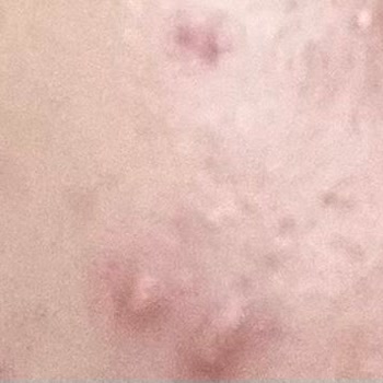 Note Cosmetics Note BB Cream Sivilce Yaptı,