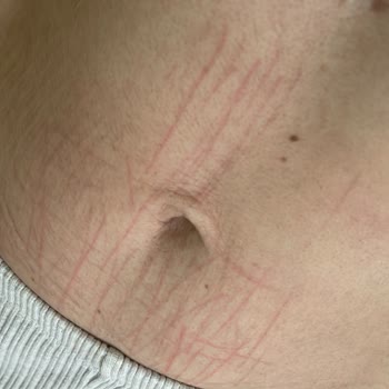 Belavil Güzellik Merkezi Buz Lazer Uygulaması Sonrası Çıkan Çizikler