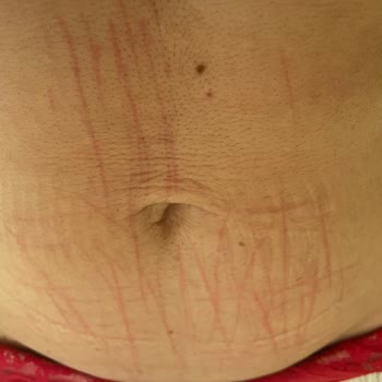 Belavil Güzellik Merkezi Buz Lazer Uygulaması Sonrası Çıkan Çizikler