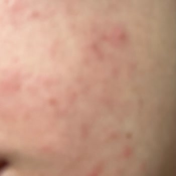 Neutrogena Yüzünden Cildim Mahvoldu Çok Pişmanım Kullandığıma