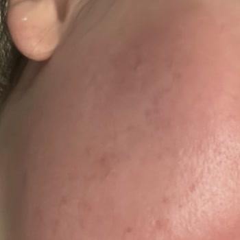 Neutrogena Yüzünden Cildim Mahvoldu Çok Pişmanım Kullandığıma