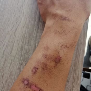 New Life Güzellik Trabzon Şubesi Yüzünden Kollarım 1. Derece Yanık!