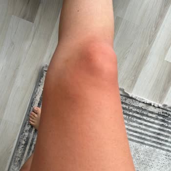 Gello Cosmetics Selülit Kreminden Cildim Yandı