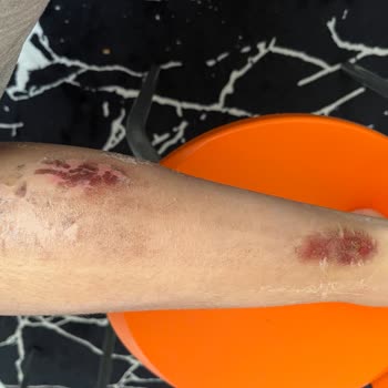 Beauty Bar Profesyonel Güzellik Merkezi Lazer Sonrası Yanık Ve Kalıcı Lekeler