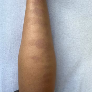 Beauty Bar Profesyonel Güzellik Merkezi Lazer Sonrası Yanık Ve Kalıcı Lekeler