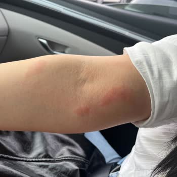 Beauty Bar Profesyonel Güzellik Merkezi Lazer Sonrası Yanık Ve Kalıcı Lekeler