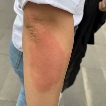 Beauty Bar Profesyonel Güzellik Merkezi Lazer Sonrası Yanık Ve Kalıcı Lekeler