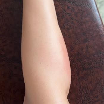 Beauty Bar Profesyonel Güzellik Merkezi Lazer Sonrası Yanık Ve Kalıcı Lekeler