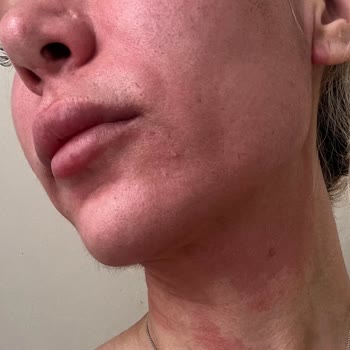 Dermokil Hyaluronik Asit Serum Kağıt Maske Yüzümü Yaktı
