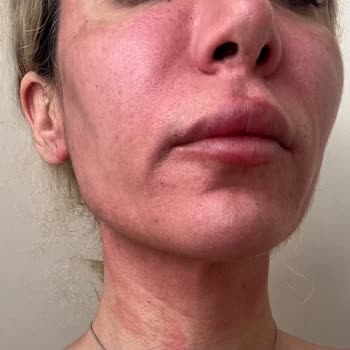 Dermokil Hyaluronik Asit Serum Kağıt Maske Yüzümü Yaktı