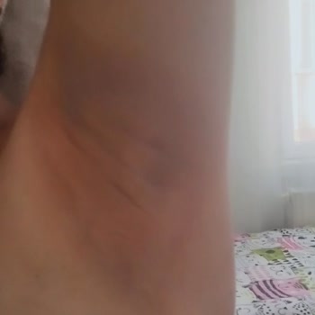 Gold Queen Estetik Koltuk Altı Kararması