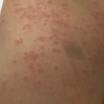 Palmolive Duş Jeli Alerji Yapıyor