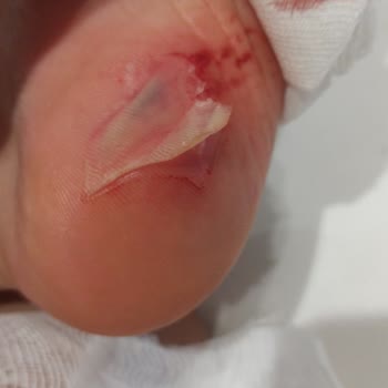 Victory Hotels Be Mine (Antalya) Aqua Parkında Yaşanan Kaza