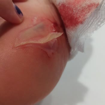 Victory Hotels Be Mine (Antalya) Aqua Parkında Yaşanan Kaza