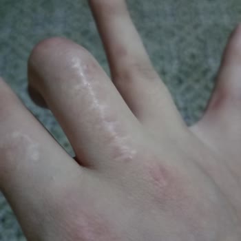 Hitit Üniversitesi Çorum Erol Olçok Eğitim Ve Araştırma Hastanesi Yanlış, Başarısız Ameliyat