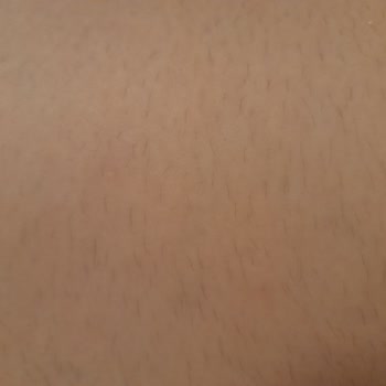 Novar Poliklinik 4 Lazer Epilasyon Sıkıntısı