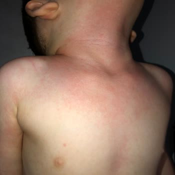 Dalin Likit Pudra Memnuniyetsizliği