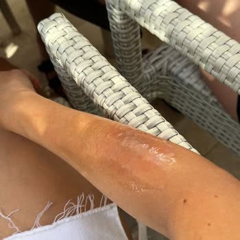 Orka Lotus Beach Hotel Kaynaklı Kaza