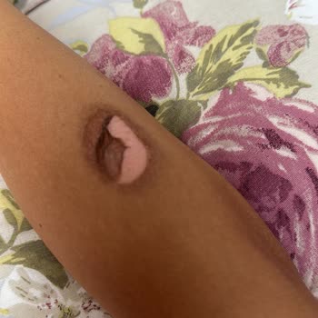 Orka Lotus Beach Hotel Kaynaklı Kaza