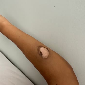 Orka Lotus Beach Hotel Kaynaklı Kaza