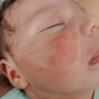 Sma Comfort Alerji Kızarıklık