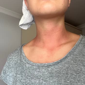 Tereson Cildimi Mahvetti Umarım Gereği Yapılır!