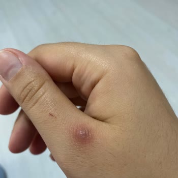 Dyson V8 Elimde Kalıcı Yara İzine Yol Açtı