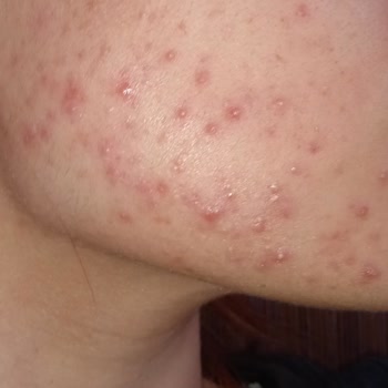 The Purest Solutions Ürünü Yüzüme Aşırı Hasar Verdi