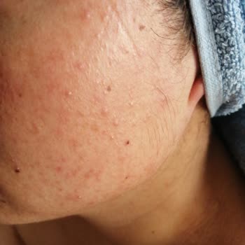 The Purest Solutions Üründe Bir Sıkıntı Olması