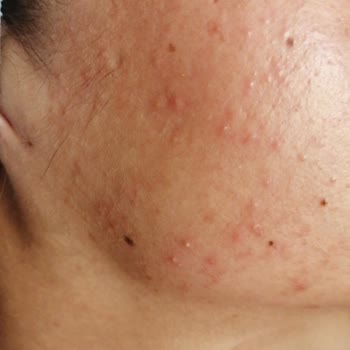 The Purest Solutions Üründe Bir Sıkıntı Olması