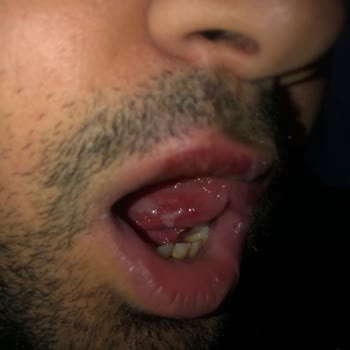 Apranax Ford Daha Önceden İçmeme Rağmen Alerji Yaptı