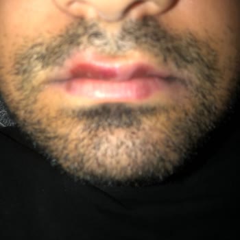 Apranax Ford Daha Önceden İçmeme Rağmen Alerji Yaptı