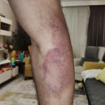 Kızılay Sağlık Damar Yolu Patlaması