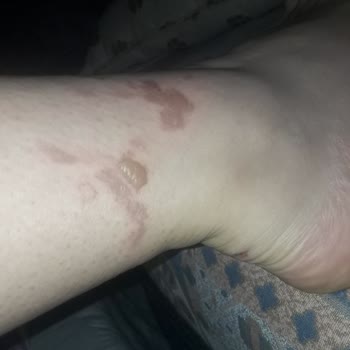 Enza Güzellik Merkezleri Buz Lazerden Bacağımın Yanması