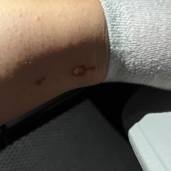 Gillette Bıçağın Ayağımı Kesmesi