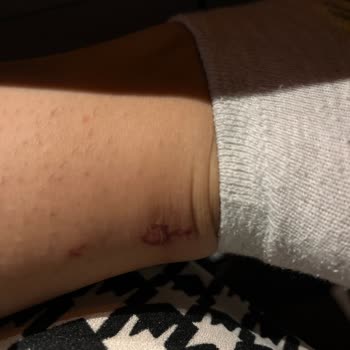 Gillette Bıçağın Ayağımı Kesmesi