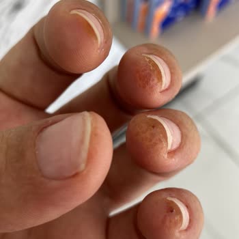 Aymira Koçaklı Yaşam Merkezi Protez Tırnak Egzamaya Çevirdi