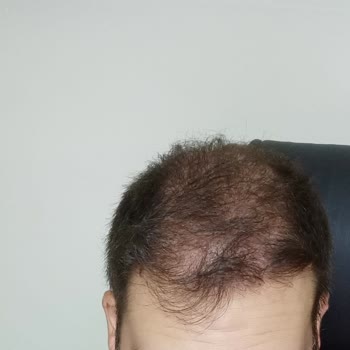 Gold City Hair İstanbul Saç Ekimini Beceremedi Beni Mağdur Etti