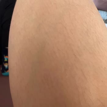 Aris Güzellik Merkezleri Aris Şikayet Buz Lazer